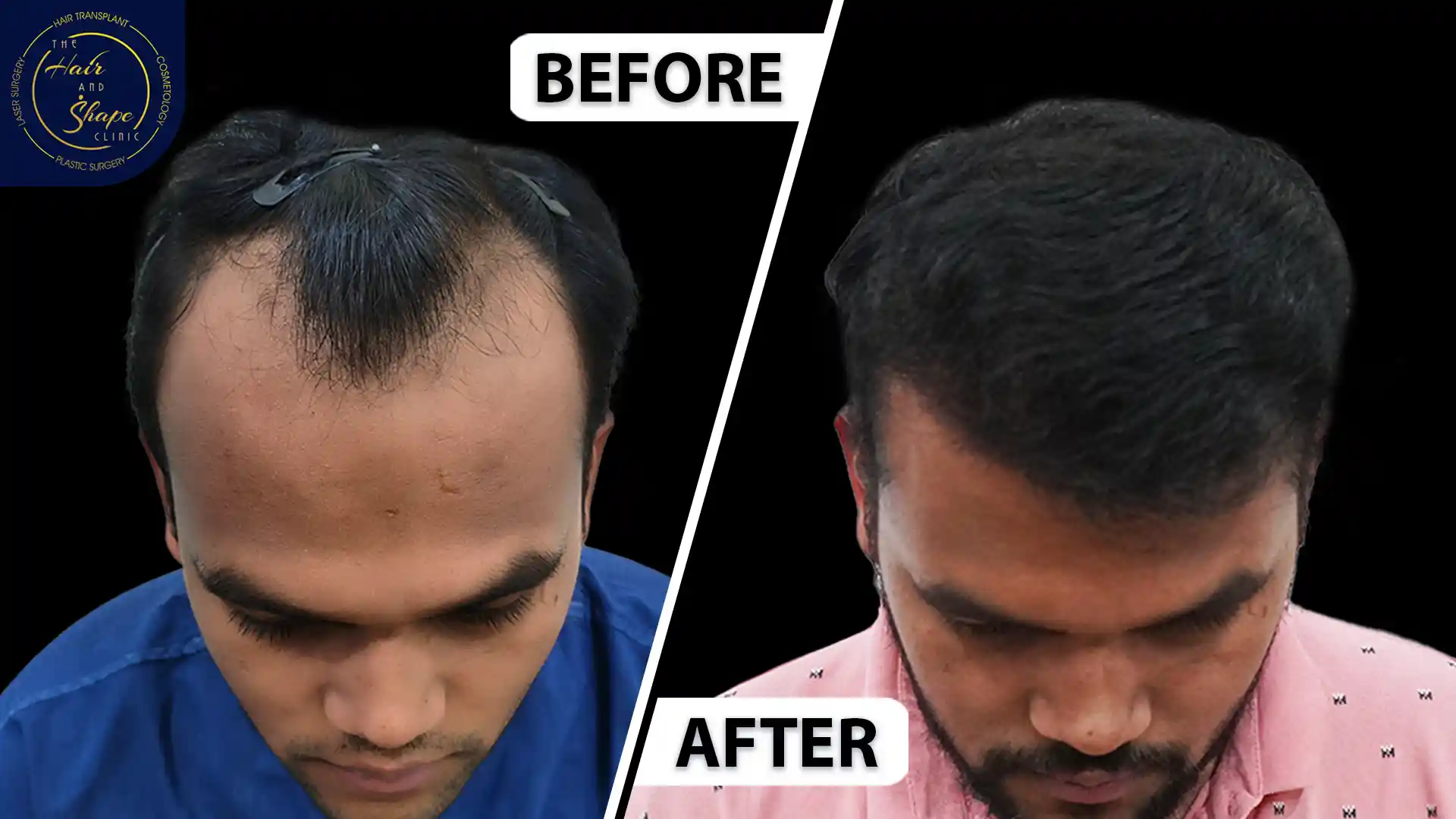 Hair Transplant result7